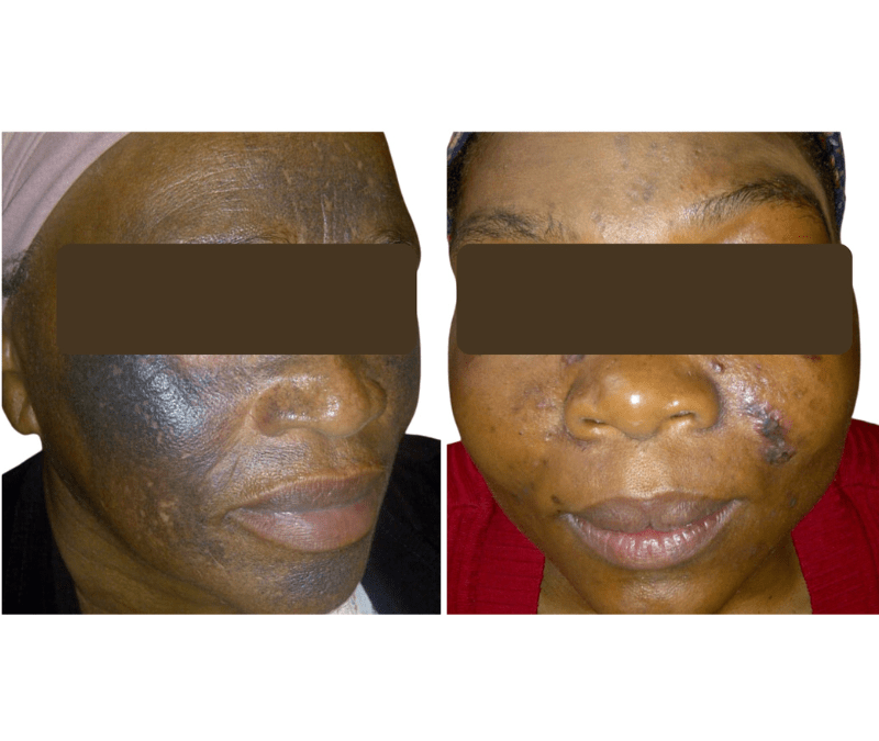 Understanding Cortisone Creams and Their Long-Term Effects